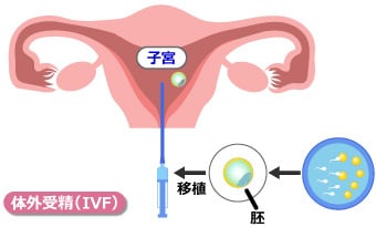 体外受精-胚移植法（IVF-ET）｜セキールレディースクリニック｜不妊治療｜体外受精｜高崎市